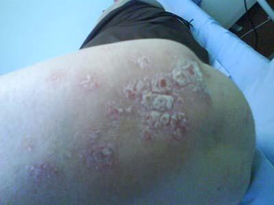 Psoriasis-2