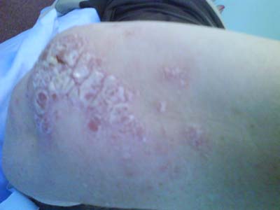 psoriasis2