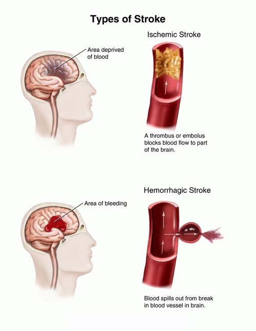 Stroke Type